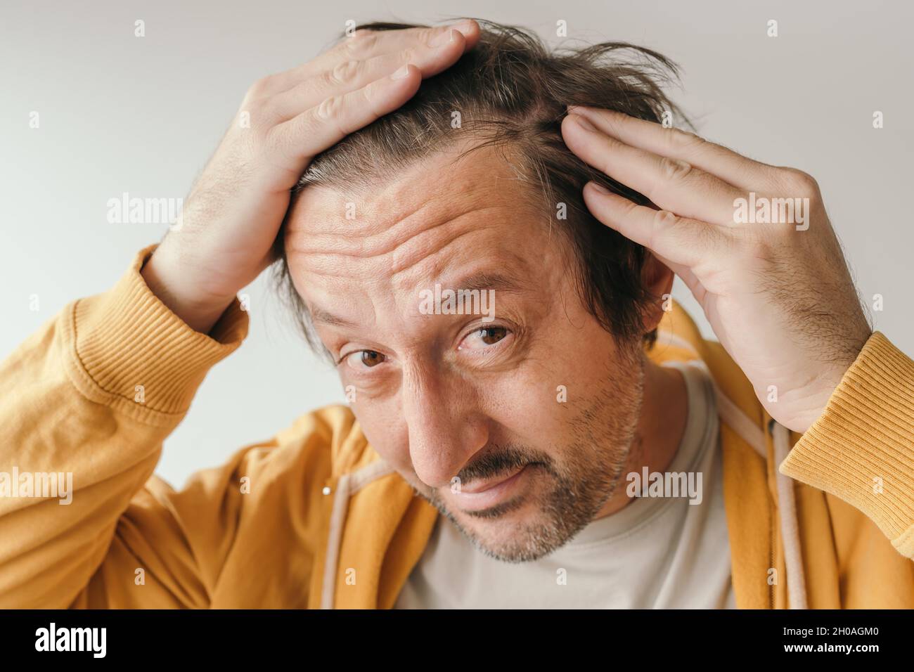 Hair loss, man looking at the mirror concerned about losing his hair at forehead, selective focus Stock Photo