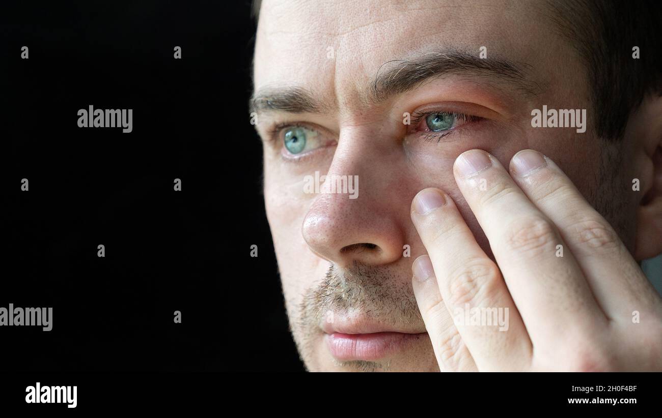 Itchy eye hires stock photography and images Alamy
