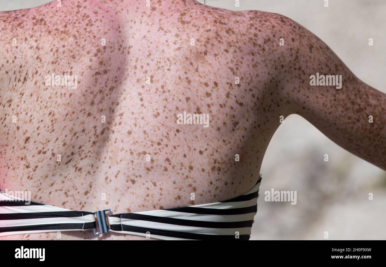 Close up of freckles on back of woman. Sensitive skin texture Stock Photo