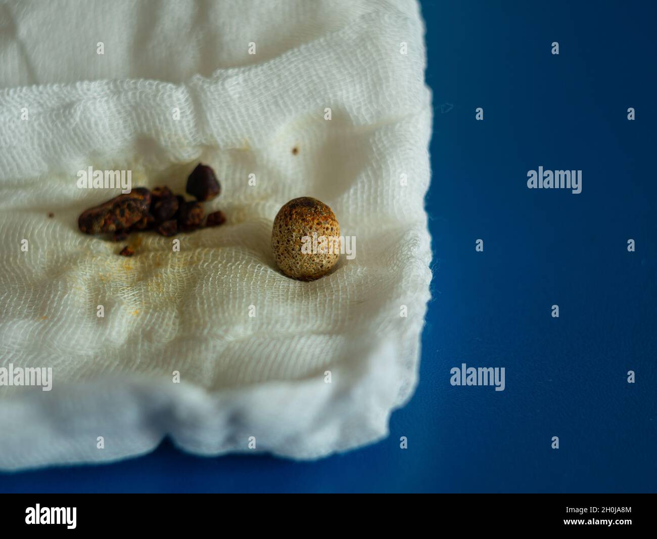 Removed gallstones on compress after gallbladder laparoscopic surgery