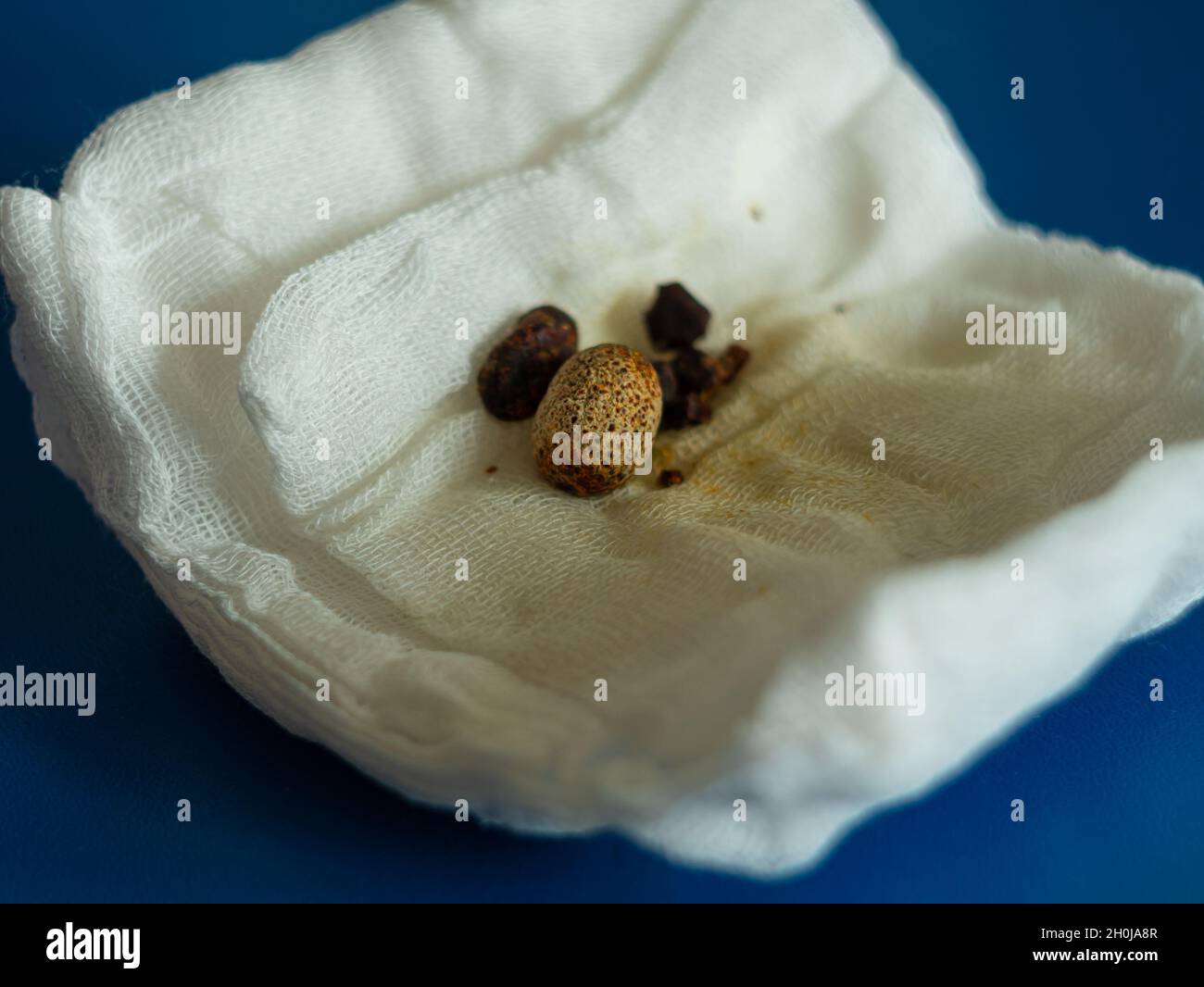 Removed gallstones on compress after gallbladder laparoscopic surgery