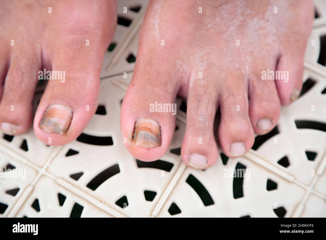 Tinea corporis at arm in Southeast Asian, Burmese young man. It is a common  fungal infection and interferes with normal pigmentation of skin resulting  Stock Photo - Alamy
