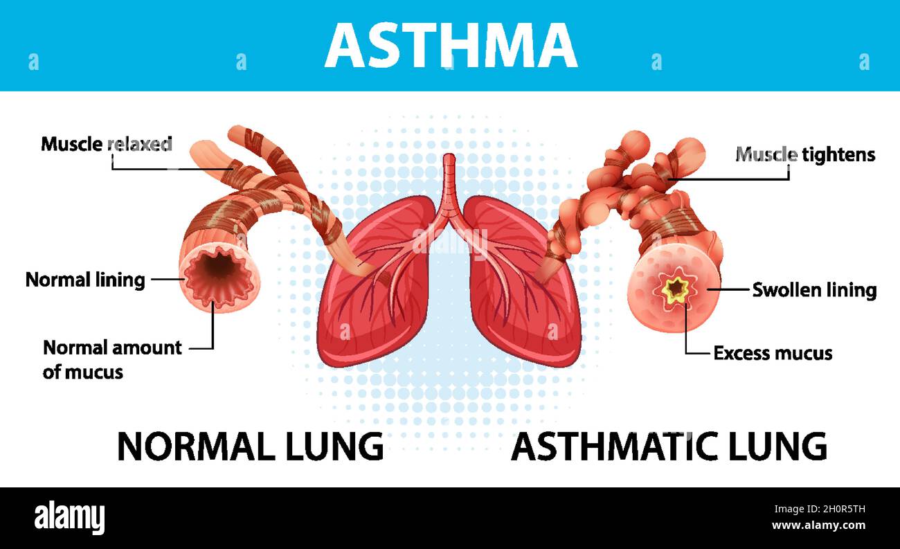 Bronchial Asthma diagram with normal lung and asthmatic lung ...