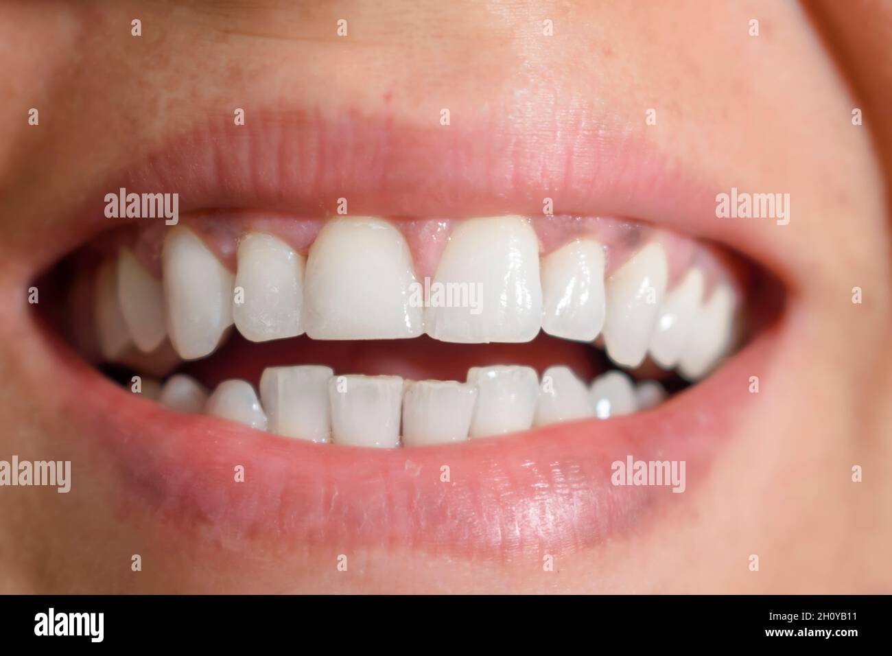 Tooth disease hires stock photography and images Alamy