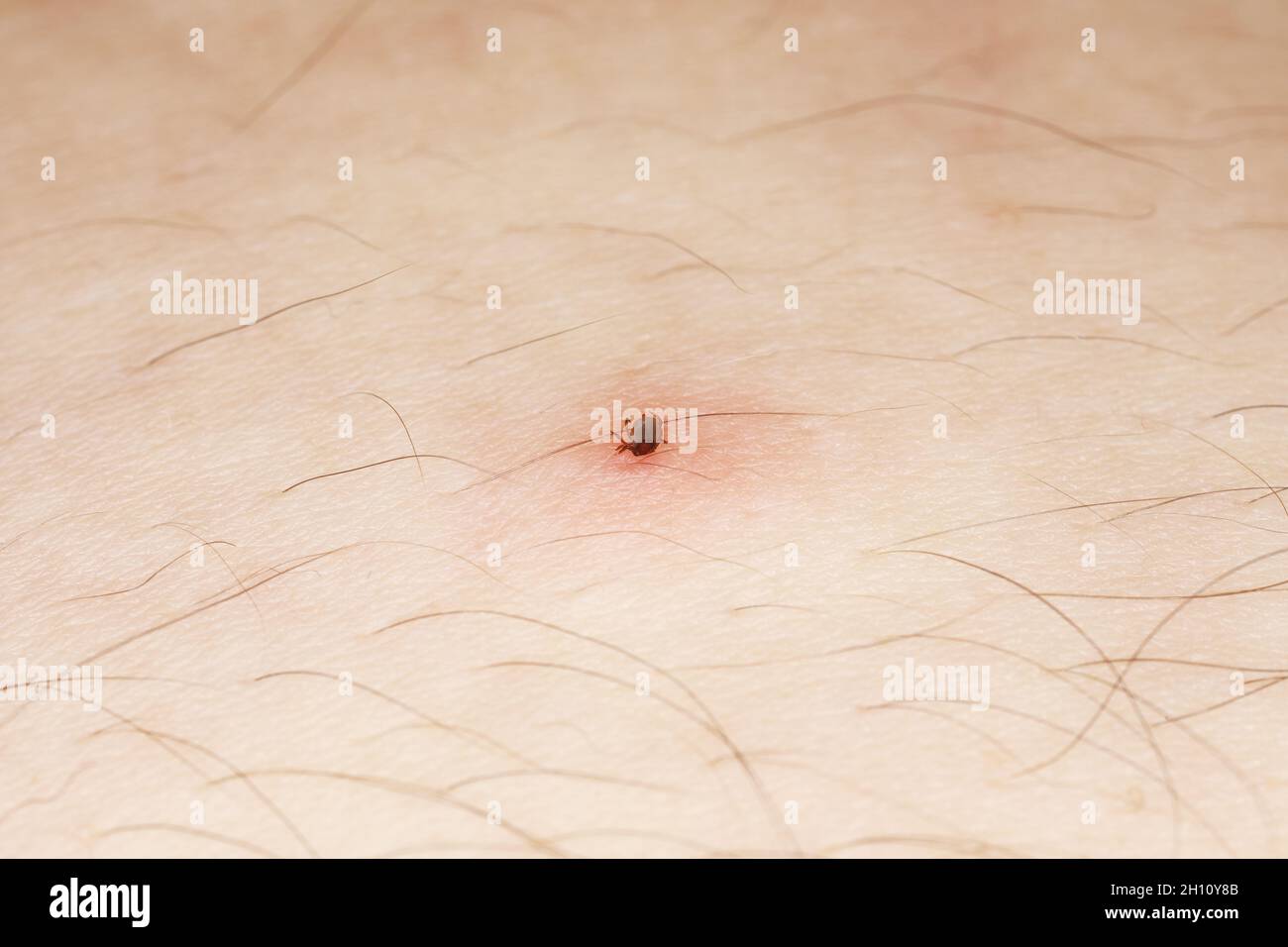 Sucking tick macro photo on human skin. Ixodes ricinus. Dangerous mite. carries pathogens that can cause disease: encephalitis, erythema... Stock Photo