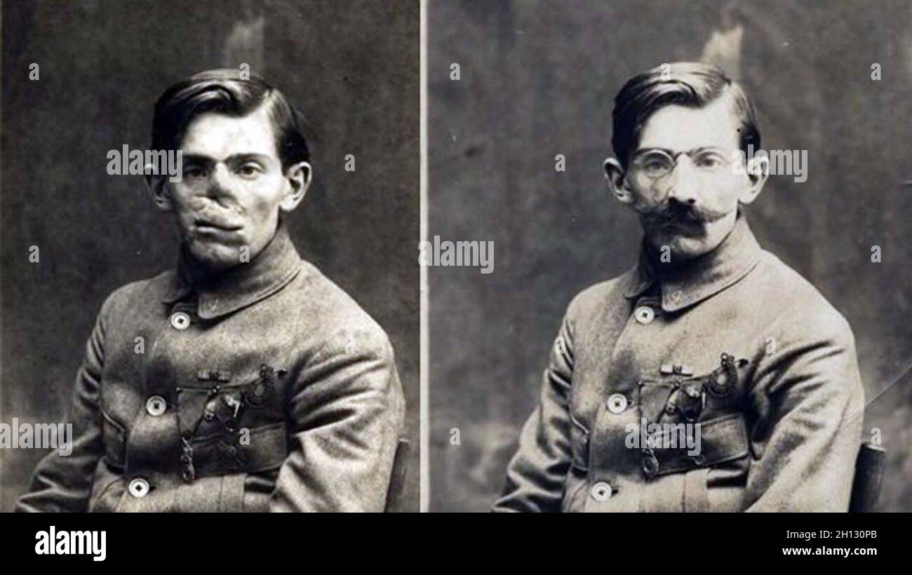 A before and after photo showing a French soldier whose face was mutilated in World War I, wearing a mask made at the American Red Cross studio of Anna Coleman Ladd, 1918. Stock Photo