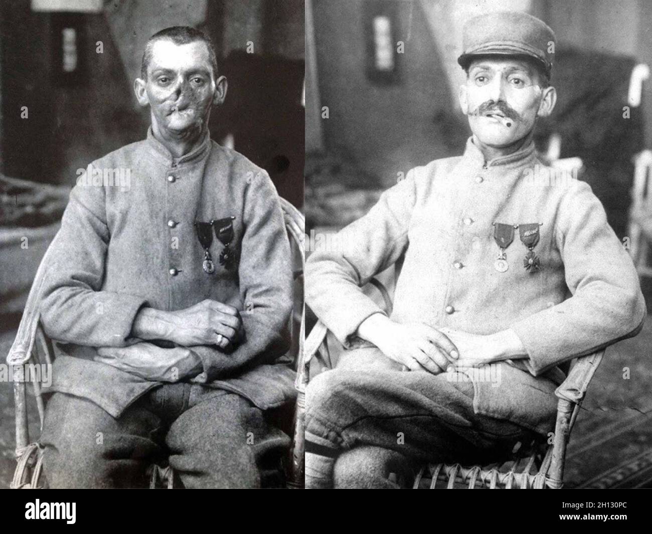 A before and after photo showing a French soldier whose face was mutilated in World War I, wearing a mask made at the American Red Cross studio of Anna Coleman Ladd, 1918. Stock Photo