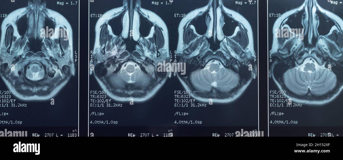 Close-up photo of an MRI of the skull and brain of a person with severe headaches; magnetic and nuclear resonance as a diagnostic method in neurology Stock Photo