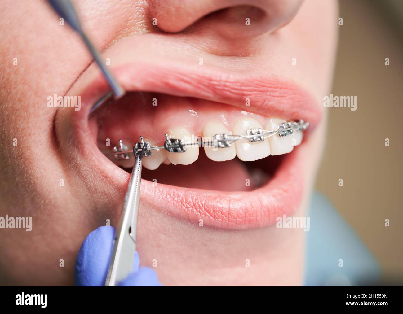 Close up of woman with brackets on white teeth receiving dental braces treatment in clinic. Orthodontist putting orthodontic braces on female patient teeth. Concept of dentistry and stomatology. Stock Photo