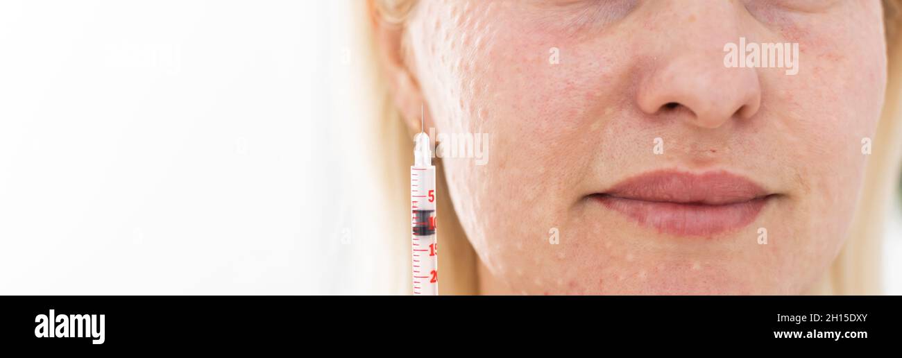 Mesotherapy in the neck and chestneckline. Traces of hyaluronic acid