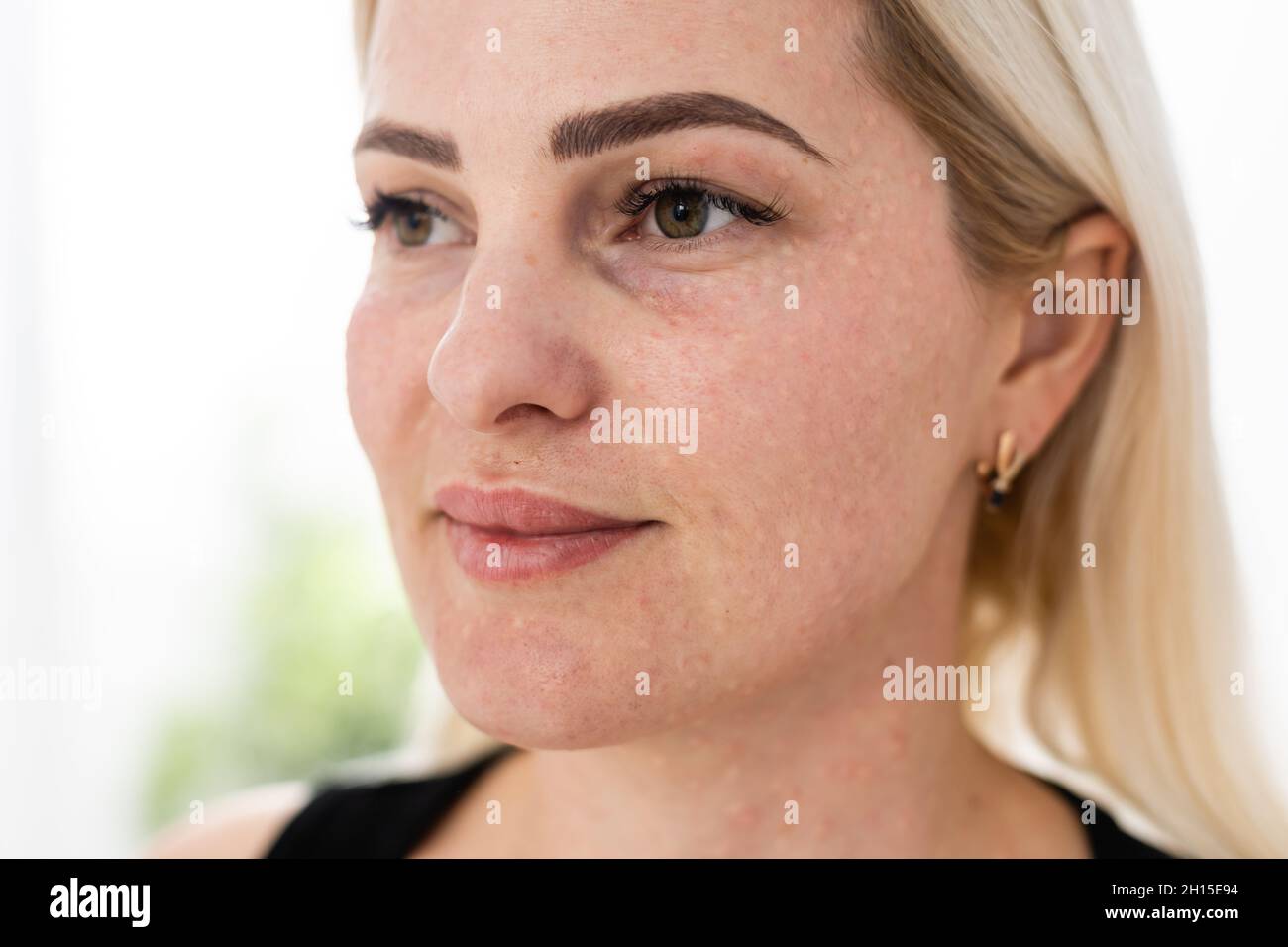 Real skin Biorevitalization on white background. Traces of  biorevitalization injections on woman face. Biorevitalization needle marks  Beauty treatment Stock Photo - Alamy