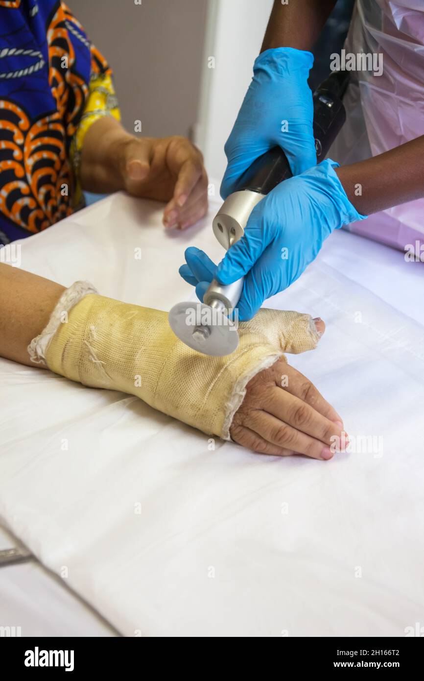 Hand In A Cast Caucasian woman with broken hands nurse removing the cast Stock Photo ...