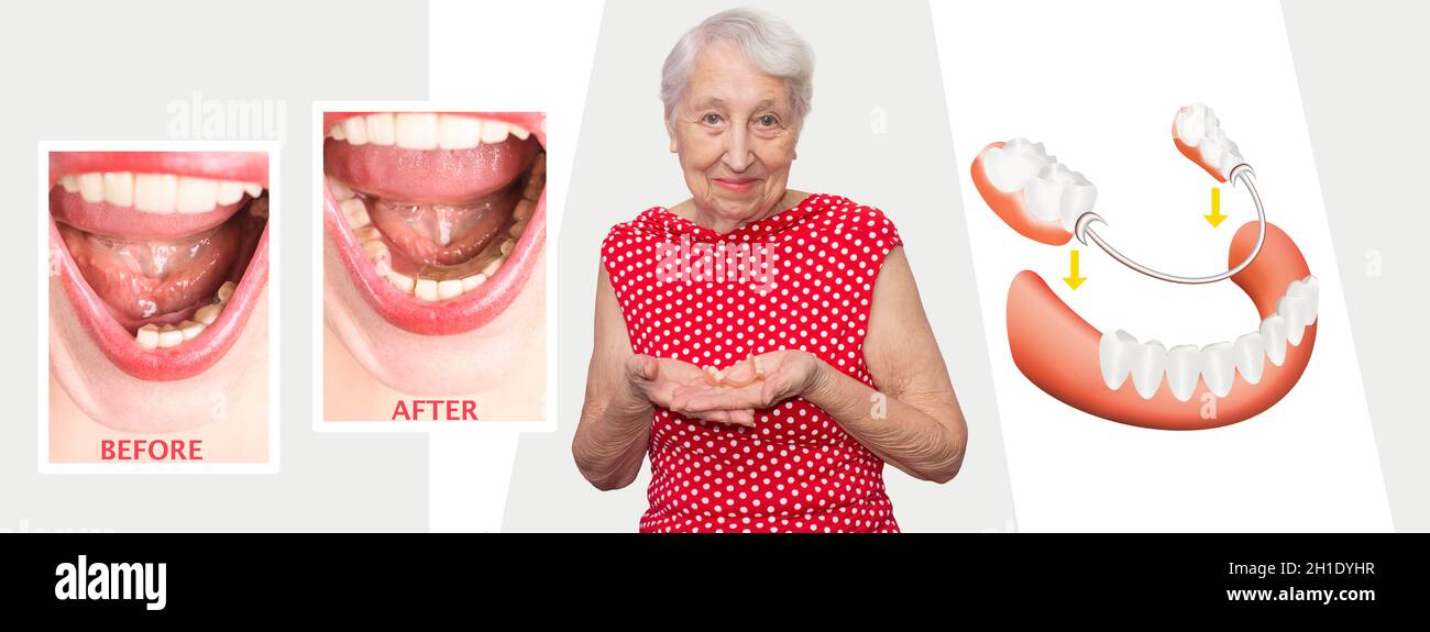 Dental rehabilitation with lower flexible nylon denture, before and after treatment. Removable dentures flexible, devoid of nylon, hypoallergenic exem Stock Photo