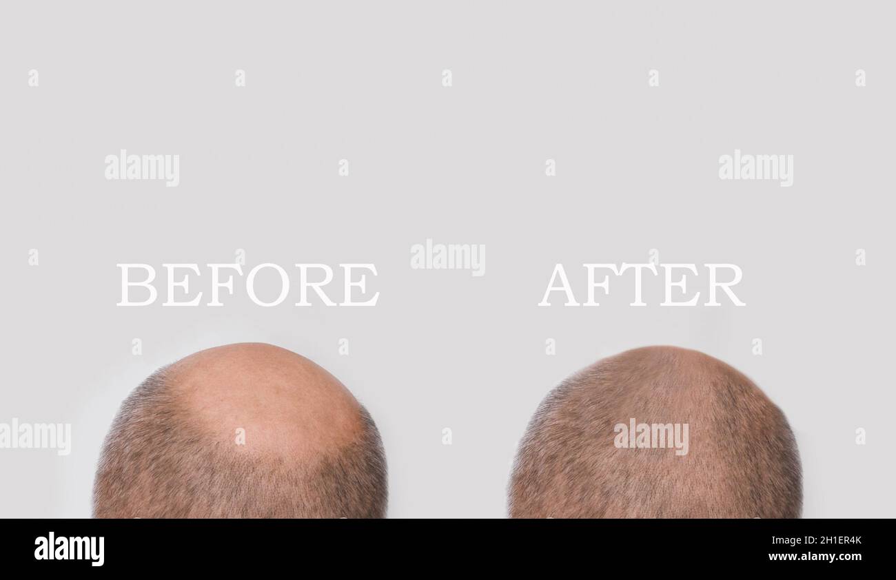 Human alopecia or hair loss - adult man hand holding comb on bald head. Before and after concept Stock Photo