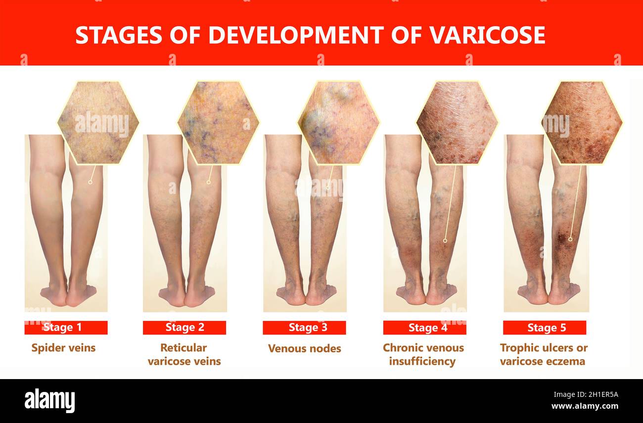Varicose veins on a female senior legs. The stages of varicose veins. The old age and sick of a woman. Varicose veins on a legs of old woman. The vari Stock Photo