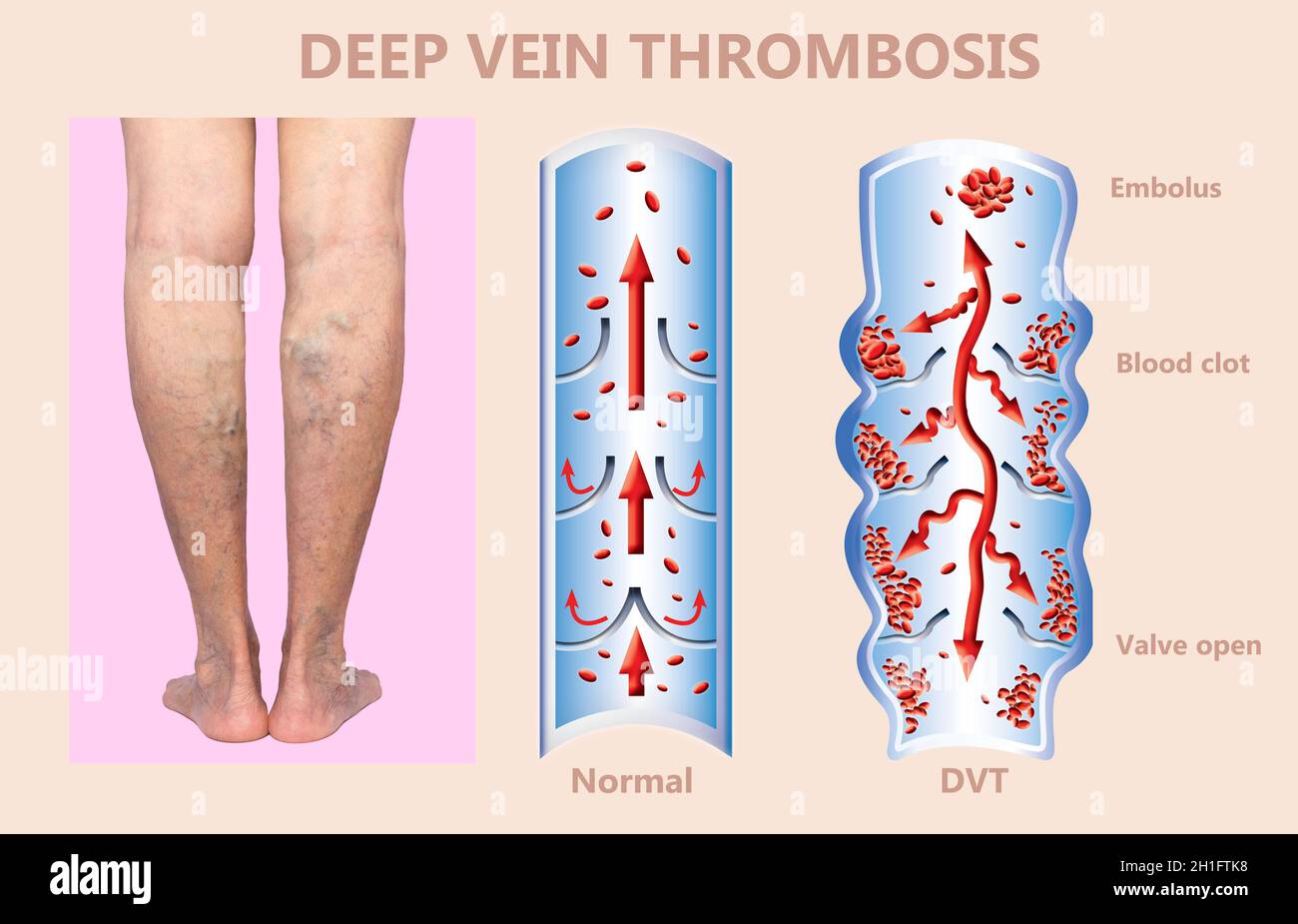 Deep Vein Thrombosis or Blood Clots. Embolus. Structure of normal and
