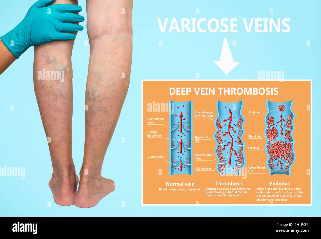 Blood Clot And Leg High Resolution Stock Photography And Images Alamy