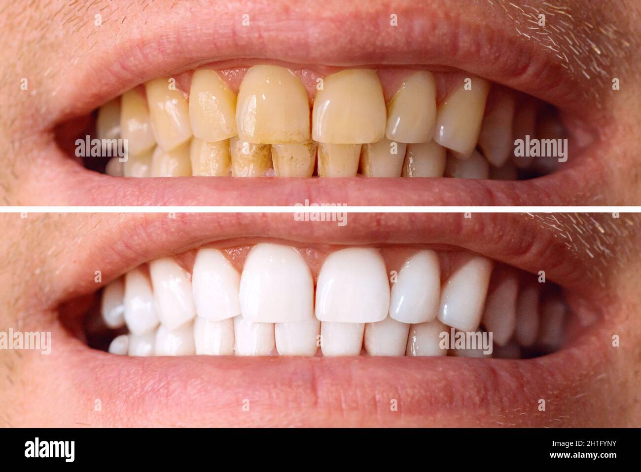 Teeth before and after whitening. Over white background. Dental clinic patient. Image symbolizes oral care dentistry, stomatology Stock Photo