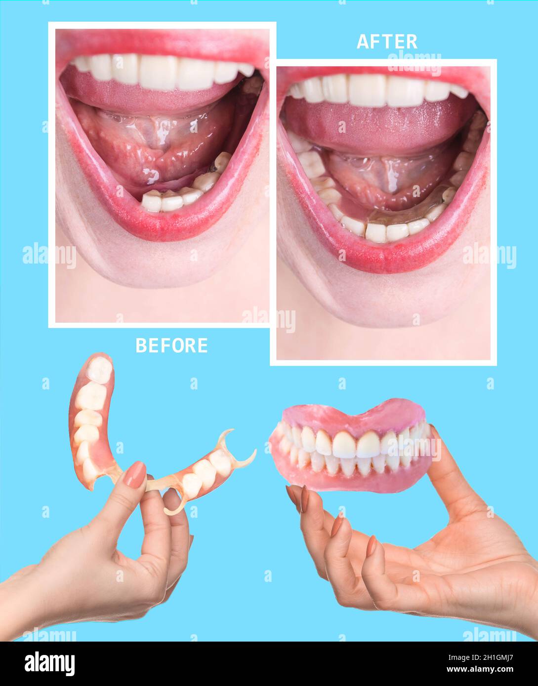 Dental rehabilitation with lower flexible nylon denture, before and after treatment. Removable dentures flexible, devoid of nylon, hypoallergenic exem Stock Photo