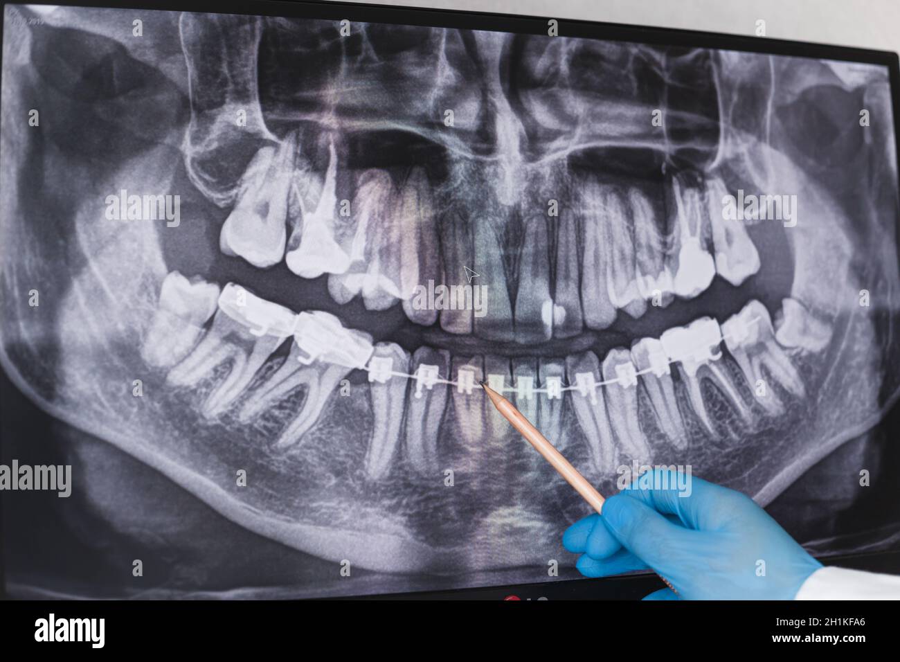 Doctor points to braces in dental xray Stock Photo Alamy