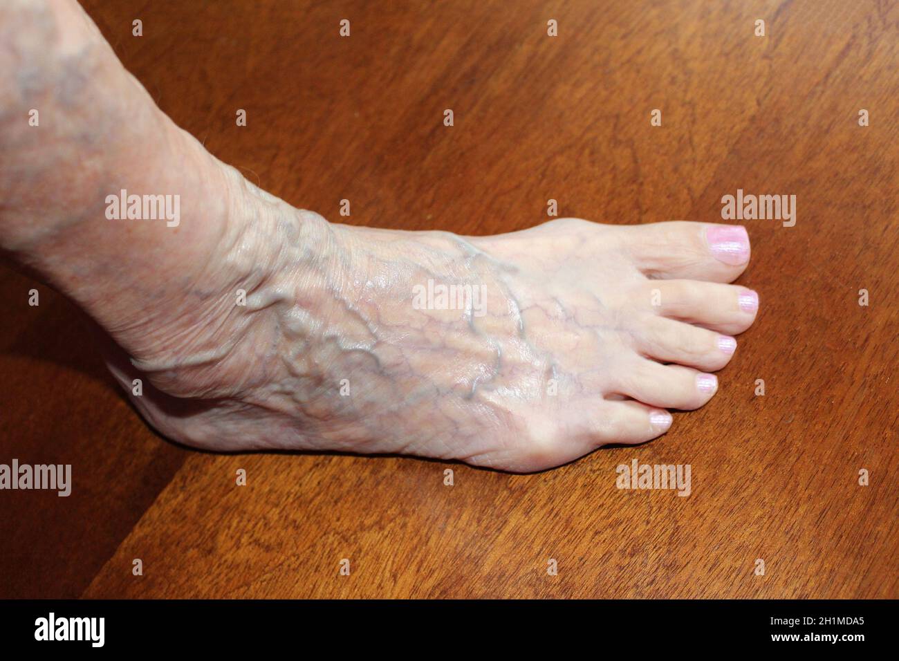 A) A 67-year-old woman represented varicose veins as well as edema