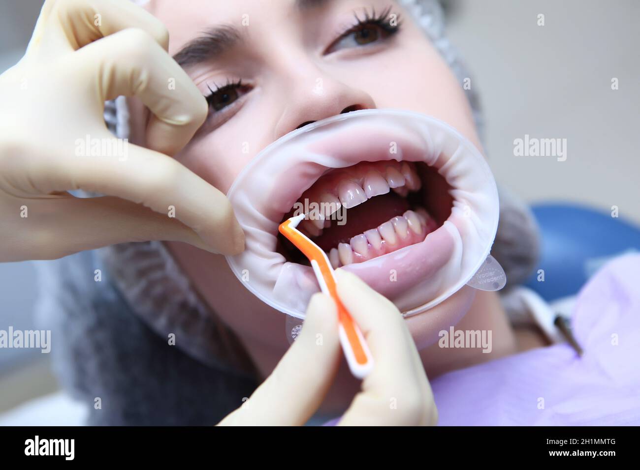 Professional cleaning of the space between the teeth. A young girl at a
