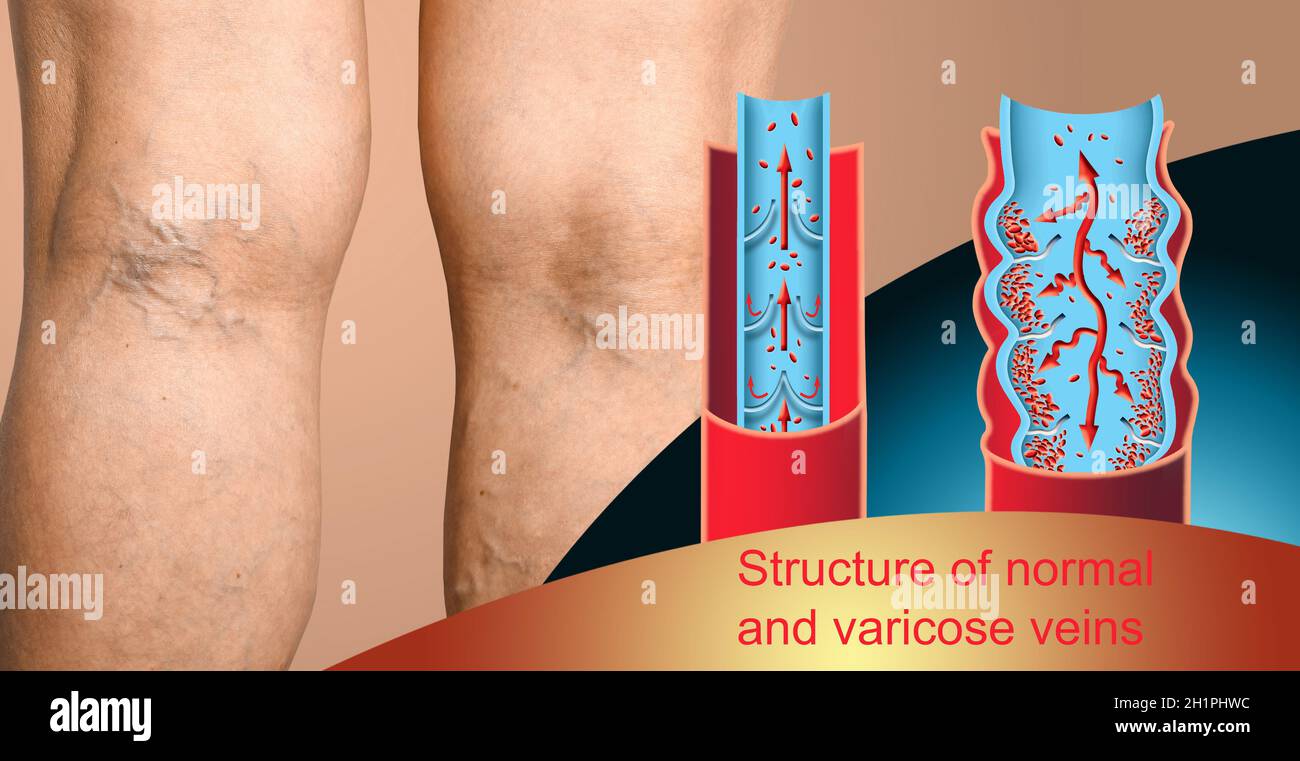 The old age and sick of a woman. Varicose veins on a legs of woman. The ...