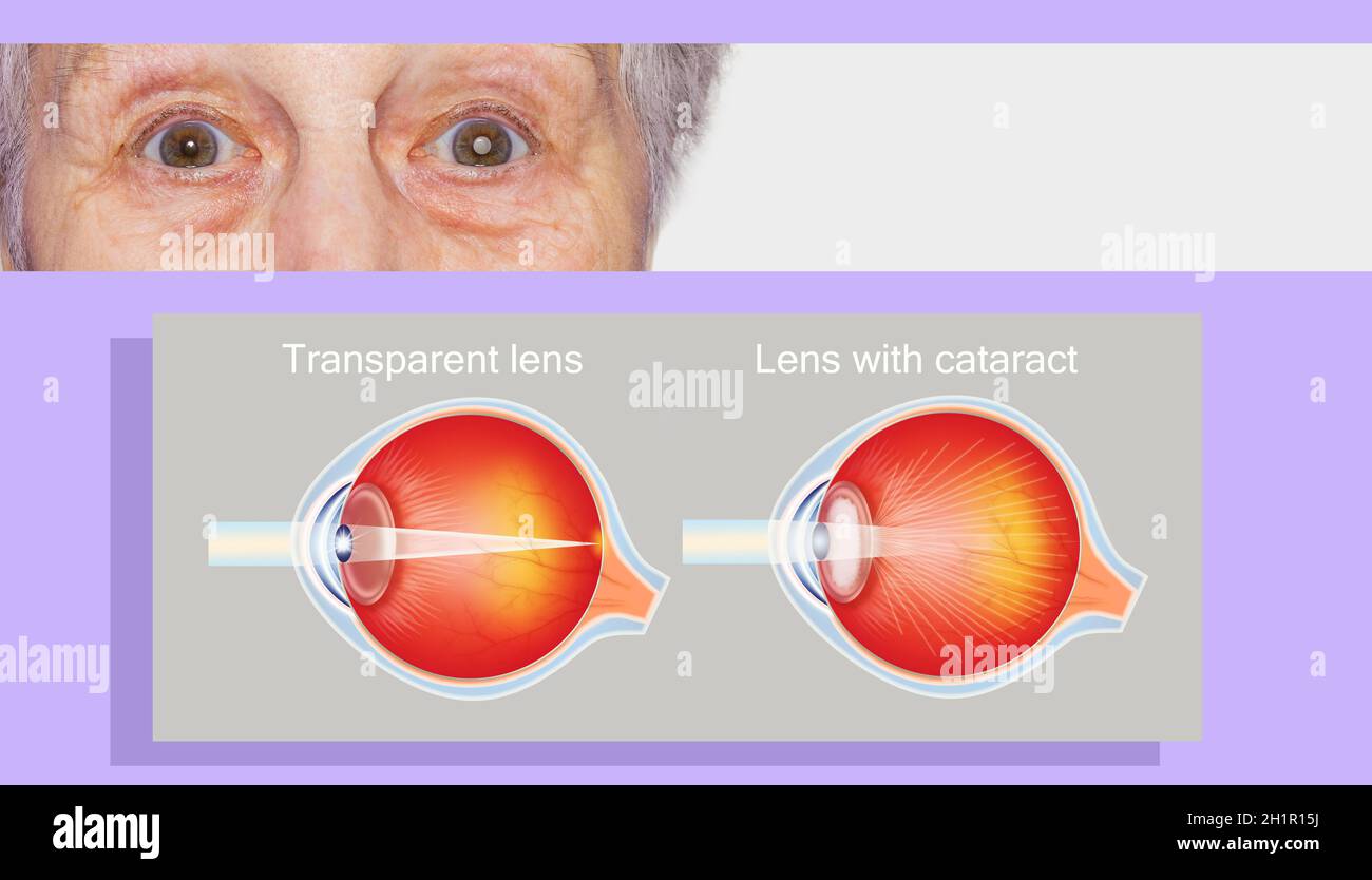 Cataract Structure Cataract concept. Senior woman's eye, closeup and cataracts and healthy ...