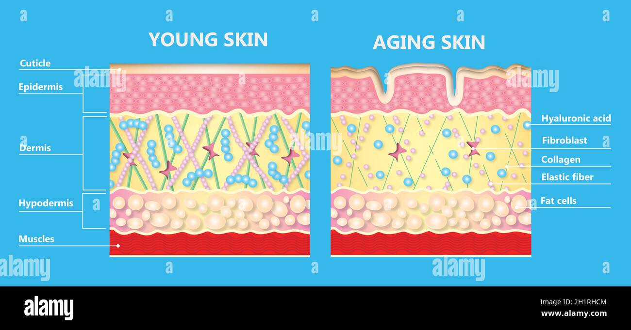 The diagram of younger skin and aging skin showing the decrease in collagen  and broken elastin in older skin. Icon Vector Illustration Stock Photo -  Alamy