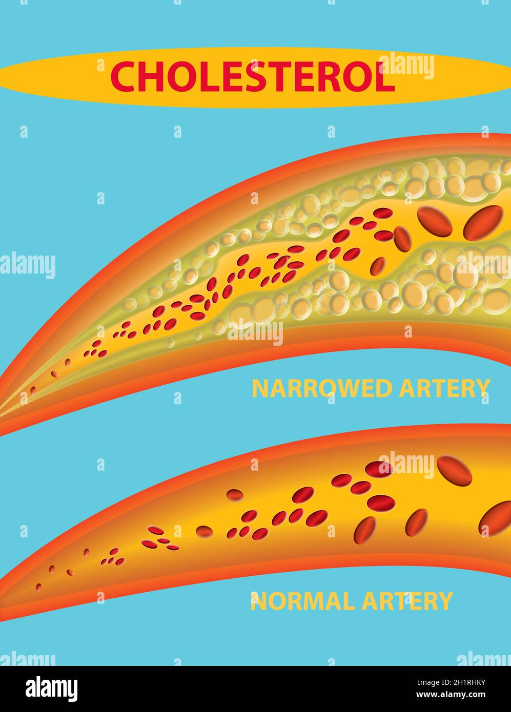 Blocked blood vessel - artery with cholesterol buildup realistic Icon ...