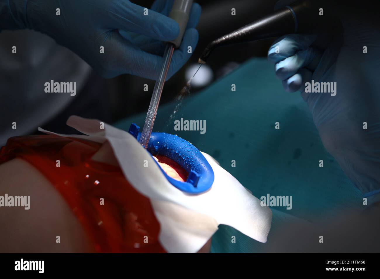 Preparation of oral cavity for bleaching.Retractor in mouth.Dental instruments in patient's