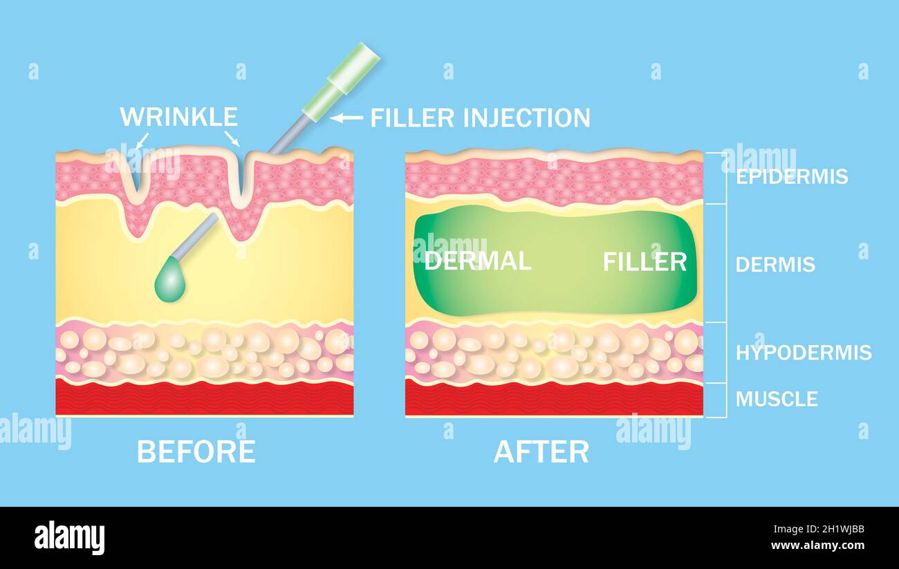 injectable cosmetic filler or Dermal fillers. before and after Stock Photo