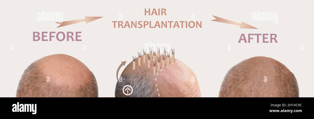 Methods of hair transplantation FUT and FUE fue with transplant as infographic element of illustration. Human alopecia or hair loss problem on adult s Stock Photo