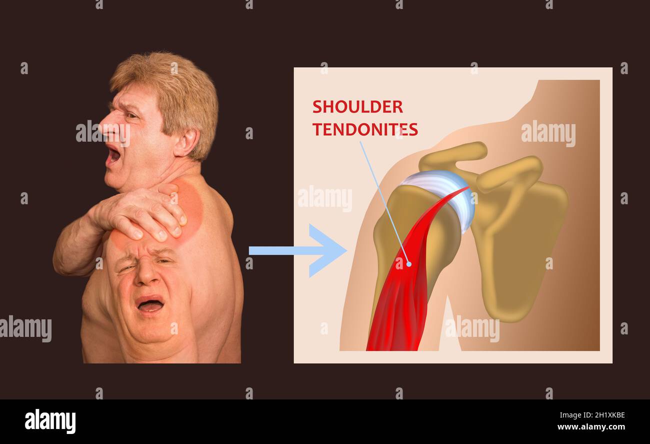 Rotator Cuff Tendonopathy — ACRO Physical Therapy & Fitness