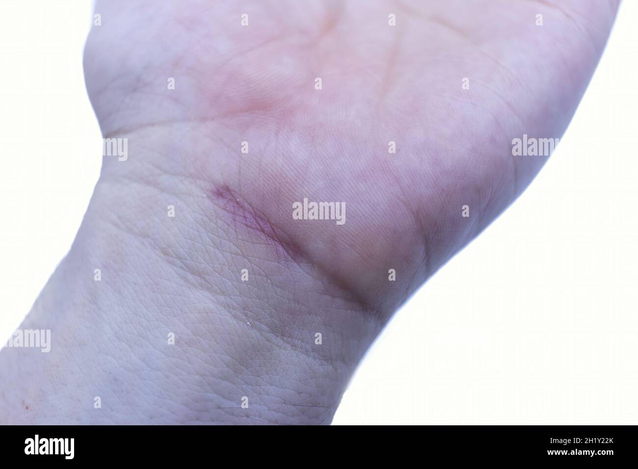 joint effusion in the wrist due to trauma due to the practice of sports