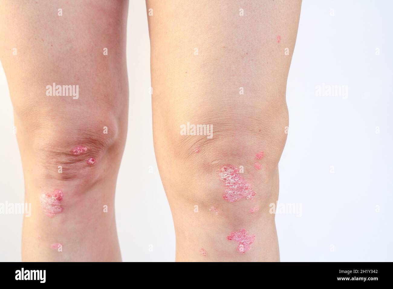 Knee joint effusion ( water on the knee).Acute psoriatic arthritis