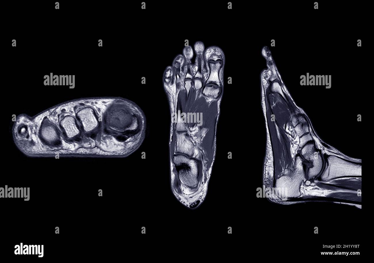 resonance imaging of foot or MRI FOOT PDW axial, Coronal and