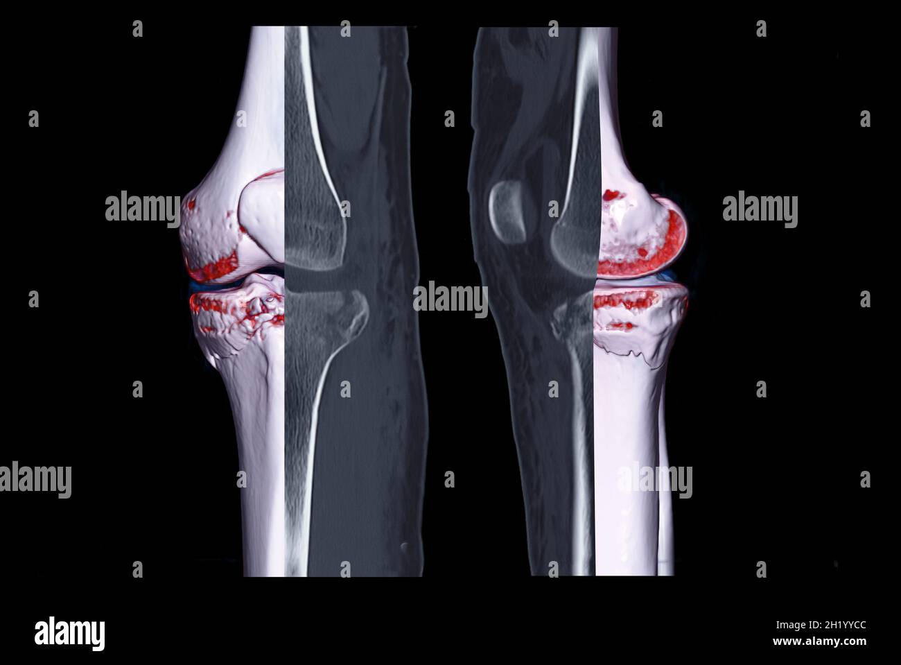 Compare of CT knee joint 3D rendering image and CT knee sagittal view