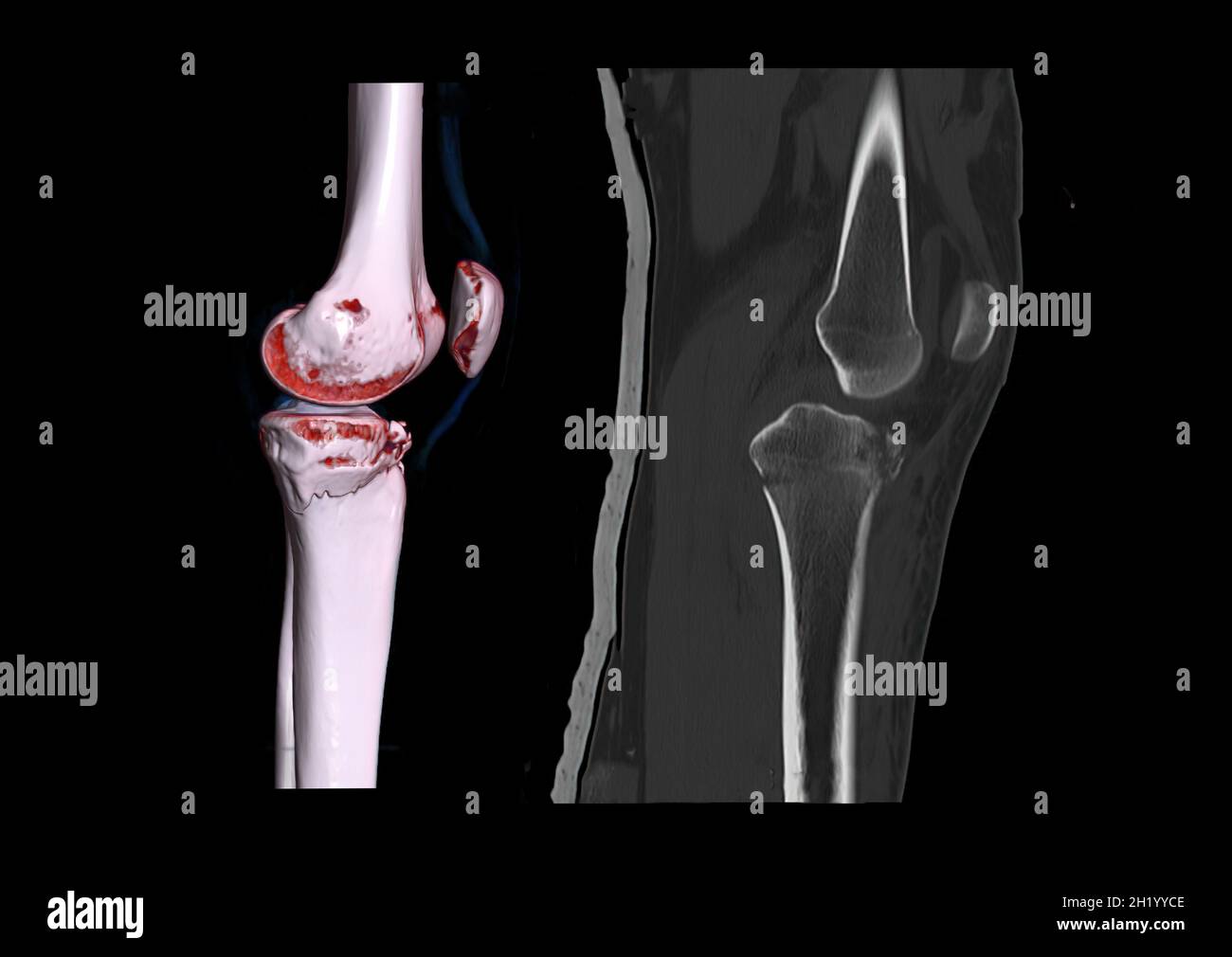 Compare of CT knee joint 3D rendering image lateral view and CT knee 2D