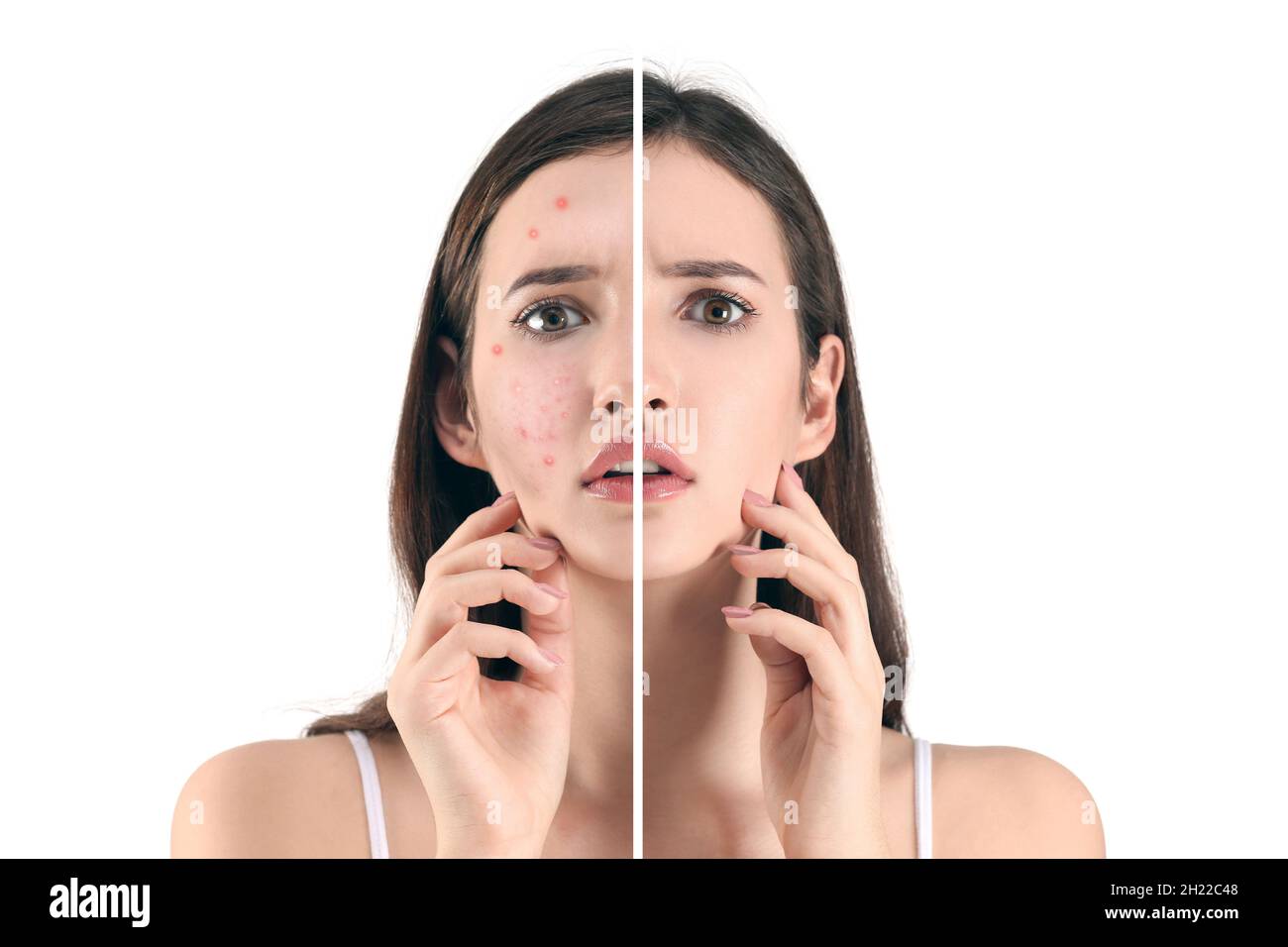 Teenager before and after acne treatment on white background. Skin care concept Stock Photo