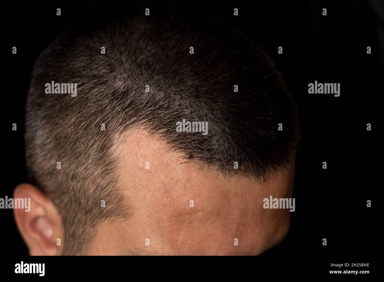 Close up photo of a man with hair loss Stock Photo