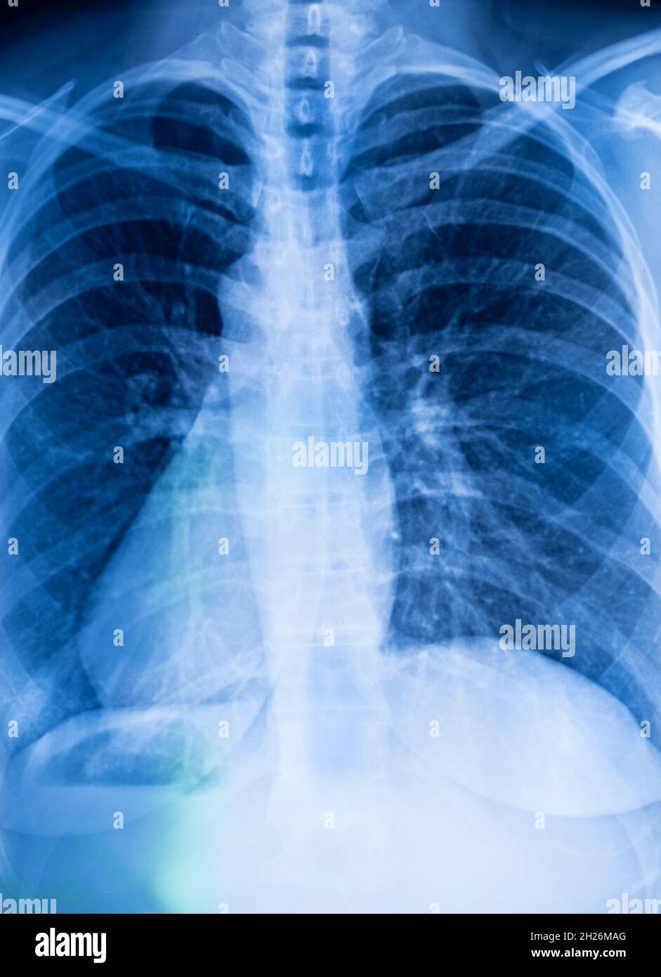 Lungs ribs xray scan test result Stock Photo Alamy
