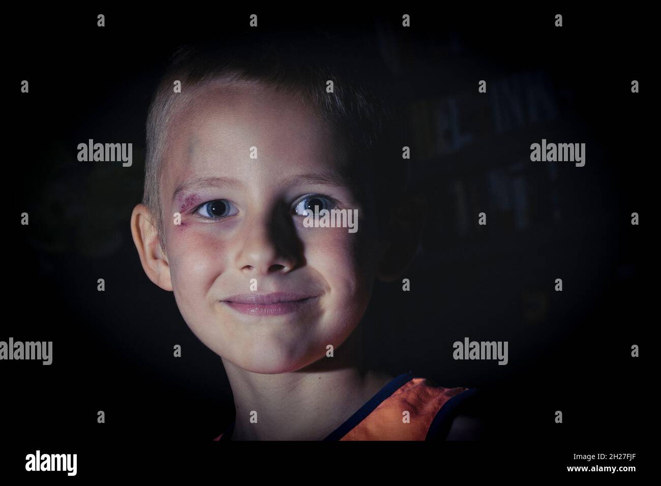 Six years old boy with bruised face after accidend or domestic violence ...