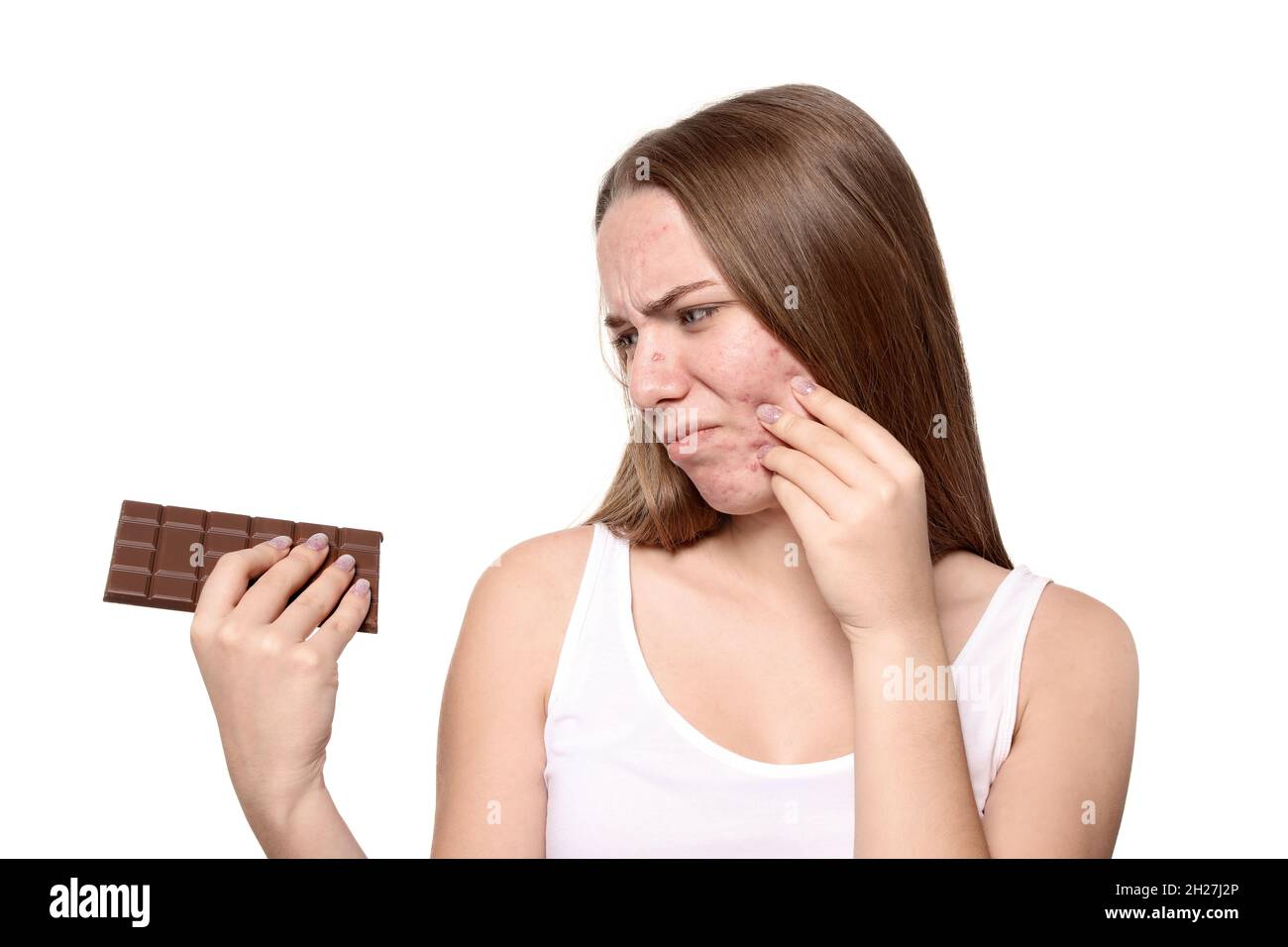 Young woman with acne problem holding chocolate bar on white background