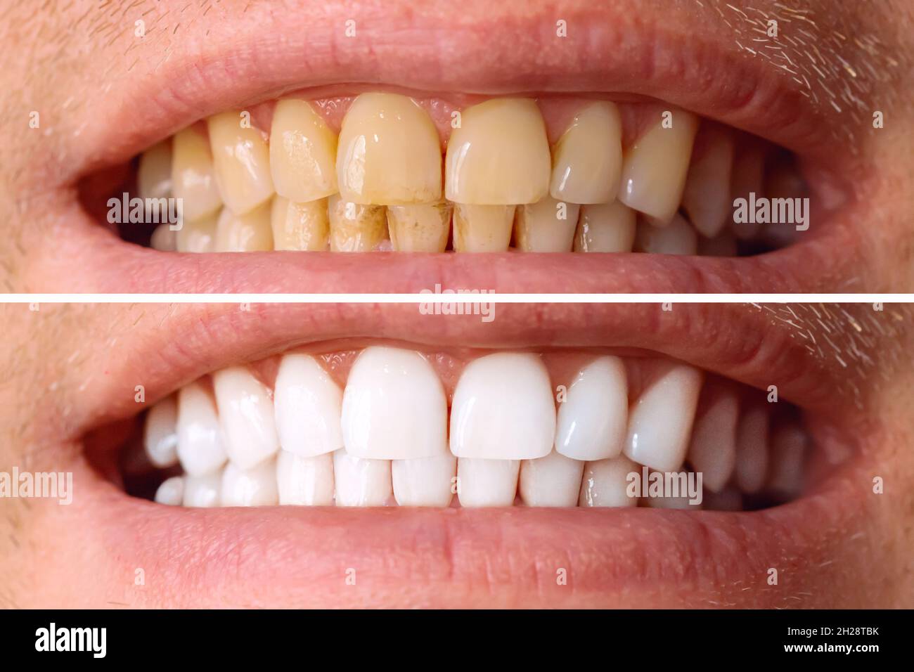 Teeth before and after whitening. Over white background. Dental clinic patient. Image symbolizes oral care dentistry, stomatology. Stock Photo