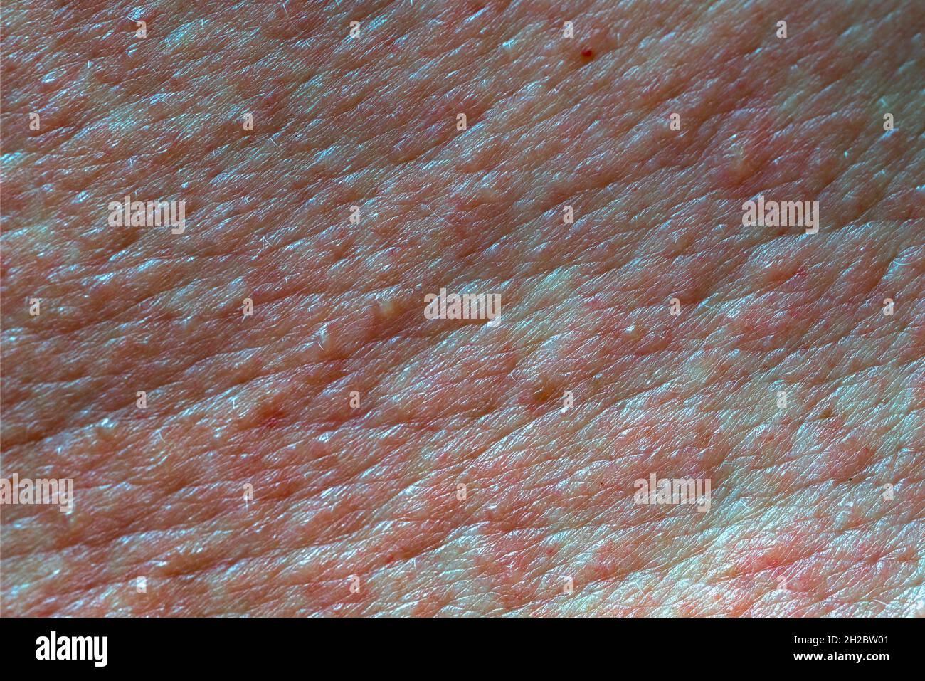 Skin texture painful in red blisters skin rashes after chemical burn Stock Photo
