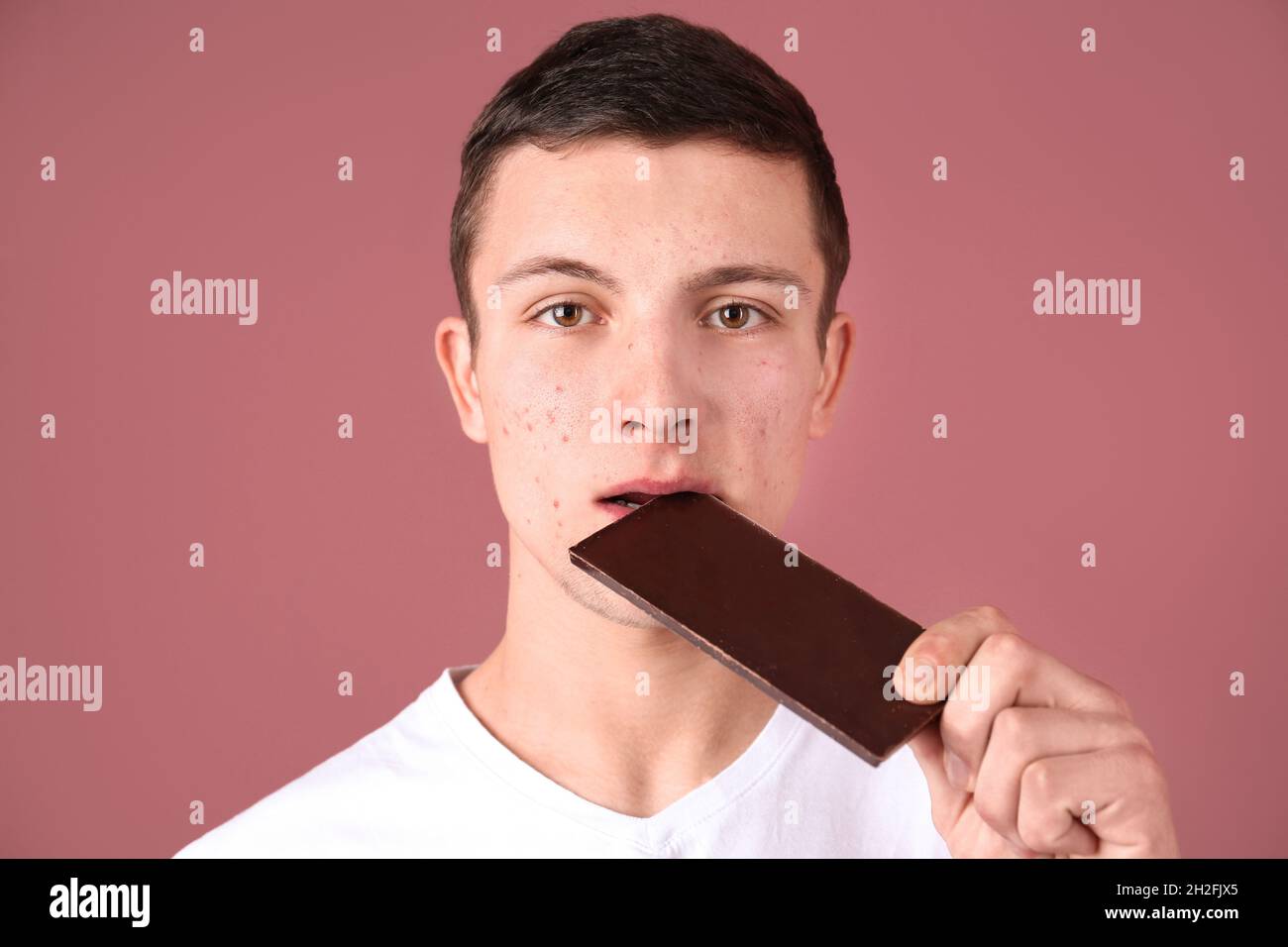 Young man with acne problem eating chocolate bar on color background