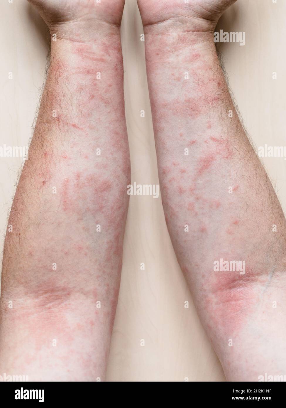 sample of Allergic contact dermatitis - male arms with itchy red rash Stock Photo