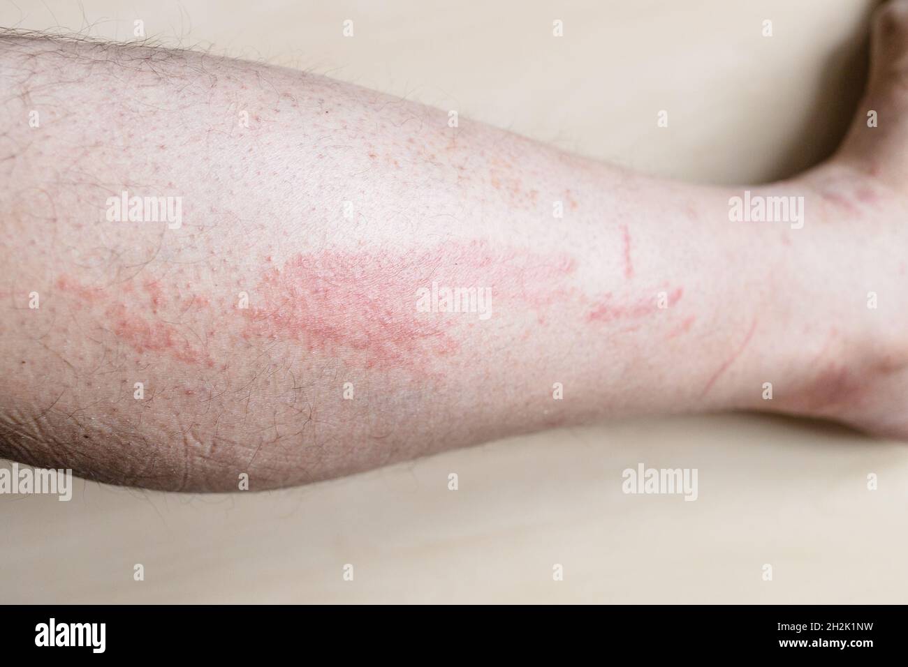 sample of Allergic contact dermatitis - side of male shin with itchy red rash Stock Photo