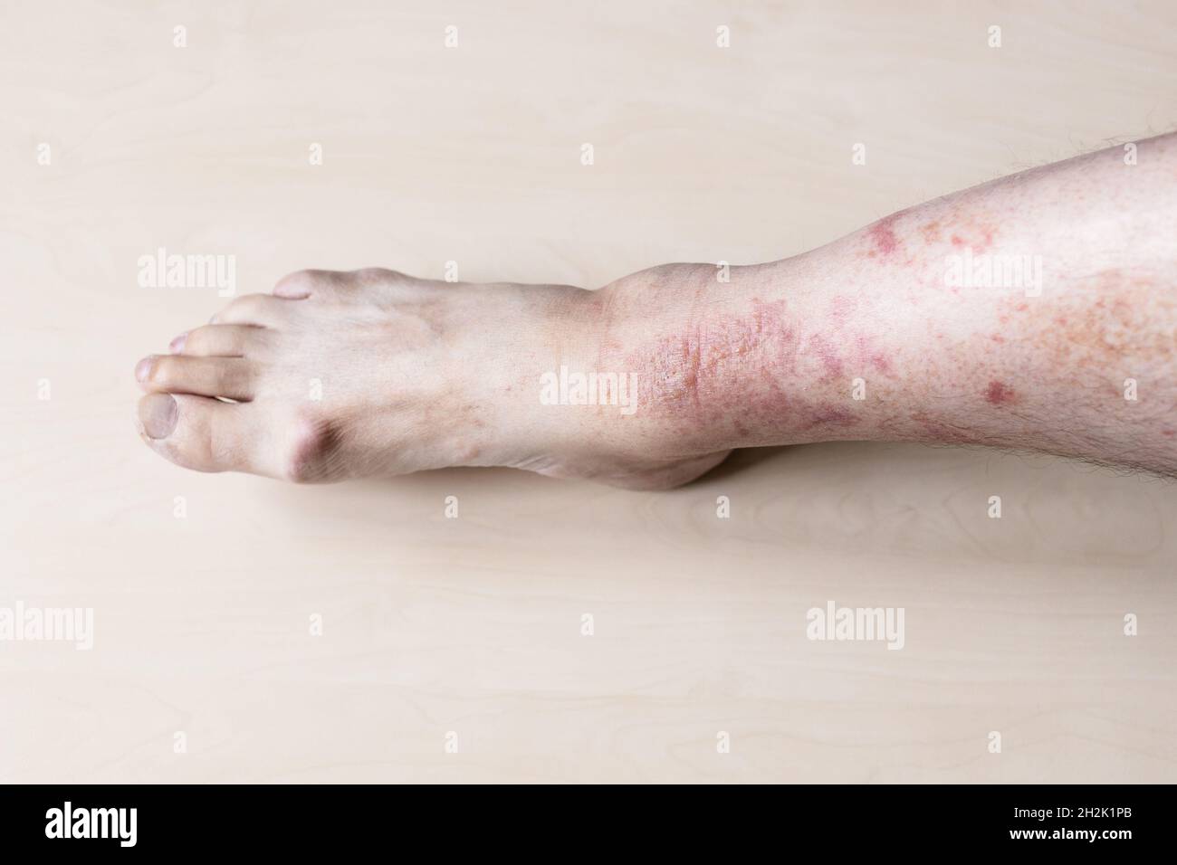 sample of Allergic contact dermatitis male shin with itchy red rash